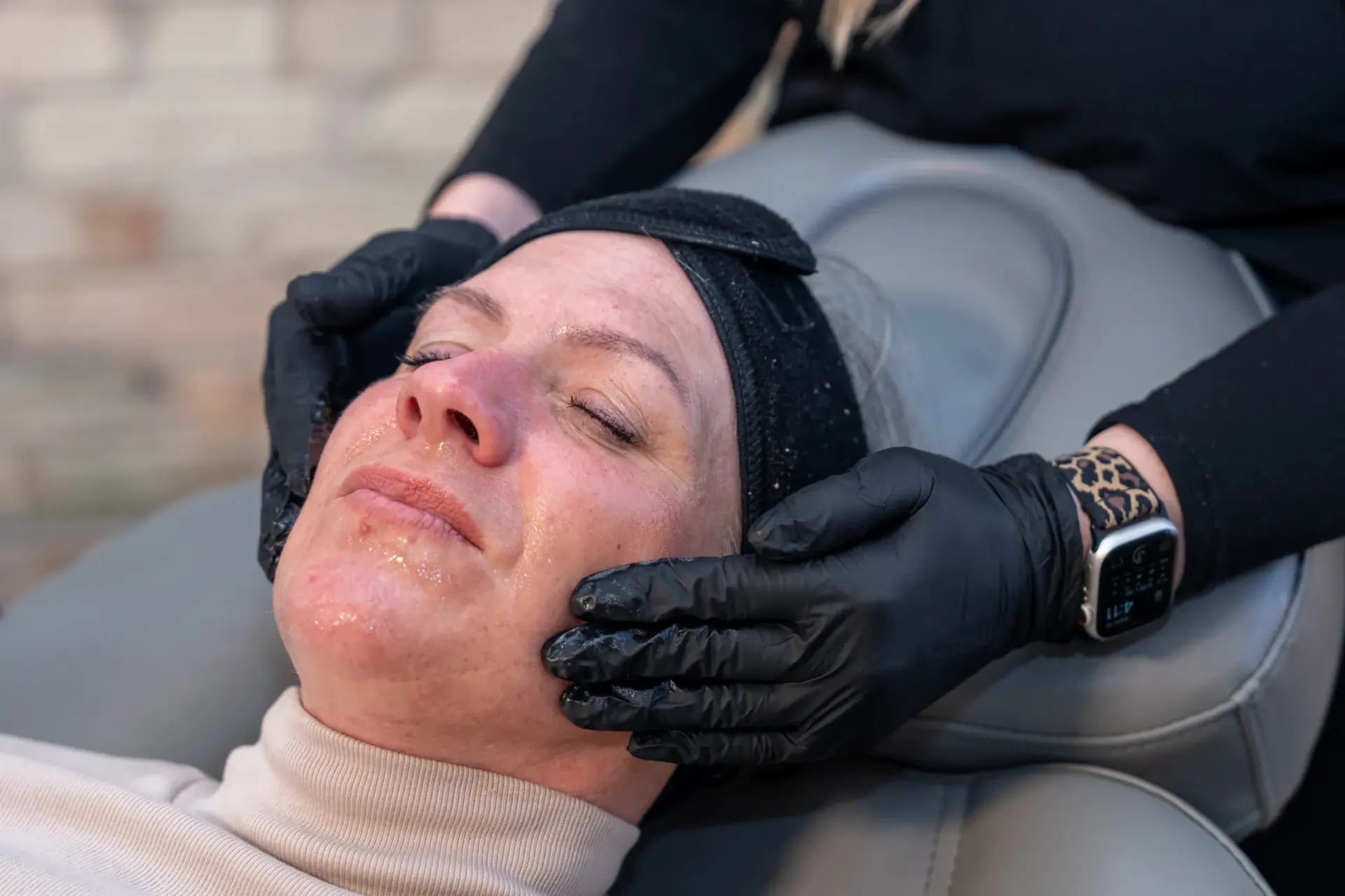 Helix CO2 laser skin resurfacing treatment at Eternal Wellness Medical Spa in Traverse City Michigan
